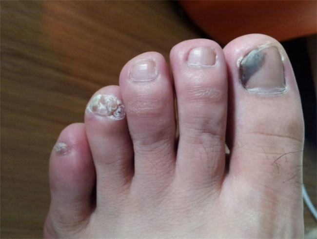 及时的治疗脚气,导致真菌爬到指甲,慢慢的出现了大脚趾有灰指甲的情况