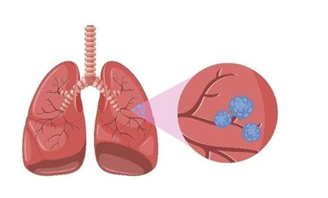 如何自测肺部是否感染