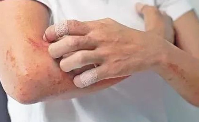 湿疹与荨麻疹有什么区别，要如何治疗