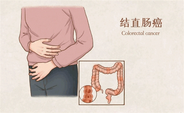 夫妻因同一习惯双双确诊结直肠癌，如何预防直肠癌
