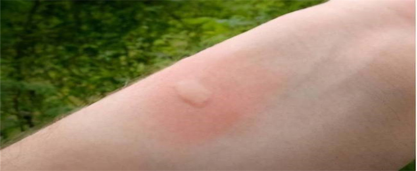 被蚊子咬后怎么快速止痒？