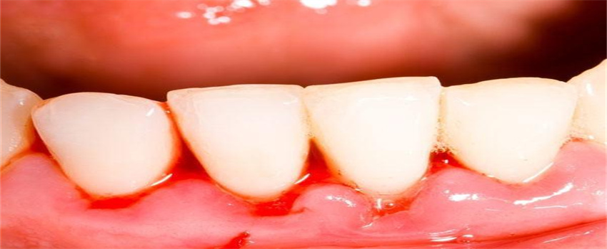 牙龈出血是什么状况