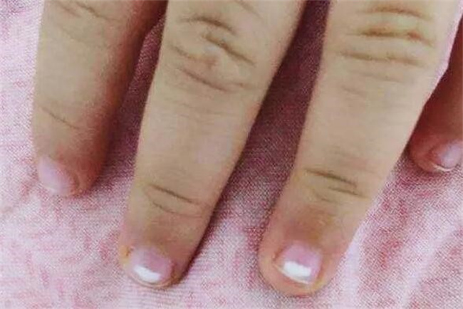 宝宝指甲上有白斑是什么原因
