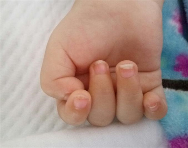 宝宝指甲异常的各种表现