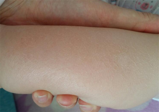孩子的皮肤出现起皮的问题怎么缓解