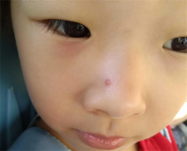 4岁小孩子鼻子上长痘痘是什么原因呢