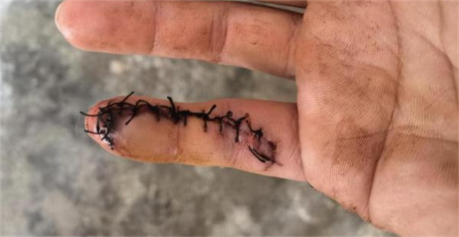 在巢湖探亲休假军人为救人手指被缝13针，徒手操作，拼命挽救