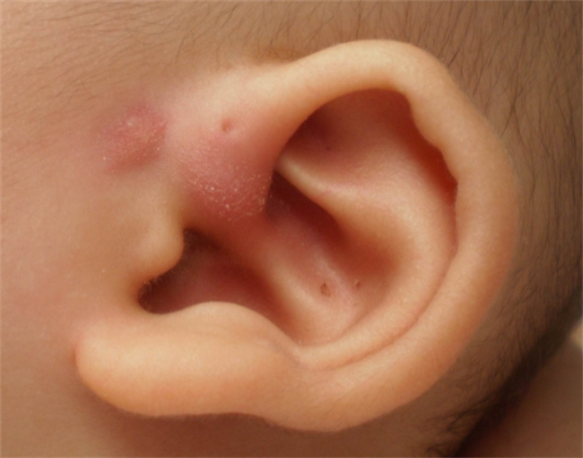 缓解孩子耳朵发炎的方法