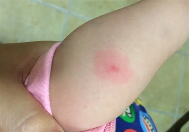 宝宝被蚊虫叮咬怎样正确处理
