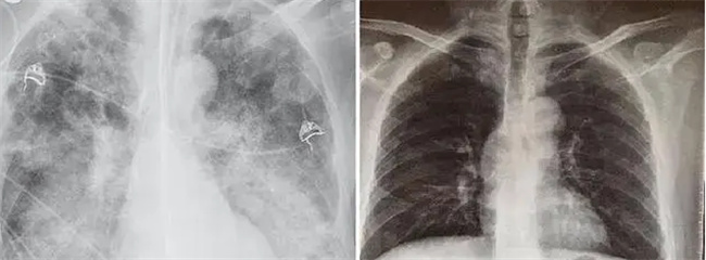 白肺是不是肺变白了