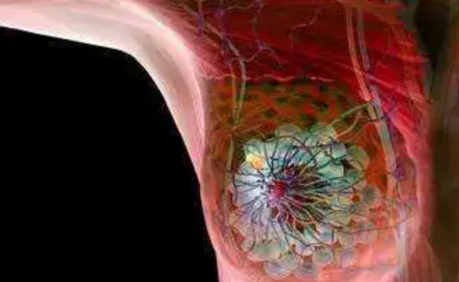 乳腺癌早期身体有什么症状，要如何预防