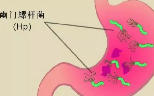 幽门螺杆菌感染会致癌及伤害大脑吗，如何预防幽门螺杆菌感染