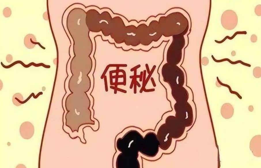一天一个健康小知识：便秘的知识点