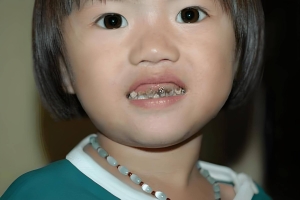 4岁孩子蛀牙牙疼怎么办 解决4岁孩子蛀牙牙疼的办法